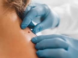 Mole & Skin Lesion Removal
